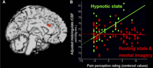 Рис. 3. (A) Зона мозга, нейронная активность в которой линейно связана с интенсивностью болевого ощущения в состоянии гипноза: красным показана вентральная часть среднепоясной коры (зона 24'a) на фоне ЯМР-изображения мозга. (B) График, показывающий связь между интенсивностью болевого ощущения и уровнем кровотока в среднепоясной коре. Видна разница в наклоне линии регрессии между гипнозом (зелёные точки) и другими состояниями (красные точки) (p<0,05). (Адаптировано, Faymonville et al.,2000; Laureys et al., в прессе).
